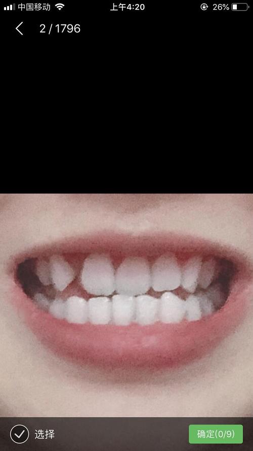 牙齿中线不齐